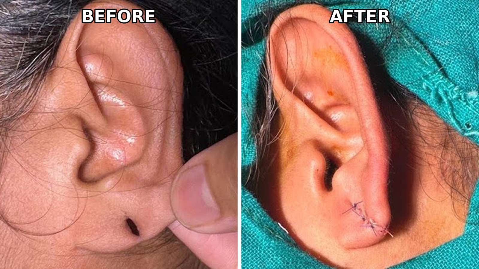 Split earlobe repair before and after — RG Plastic Surgery, Muzaffarnagar